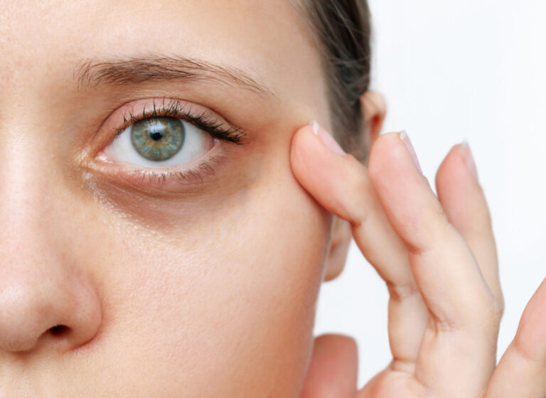 Beat Dark Circles, Sunken, And Puffy Eyes With These Remedies