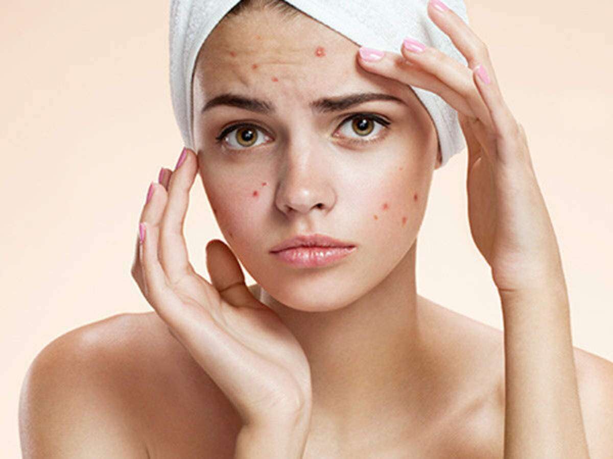 Home Remedies For Hard Pimples