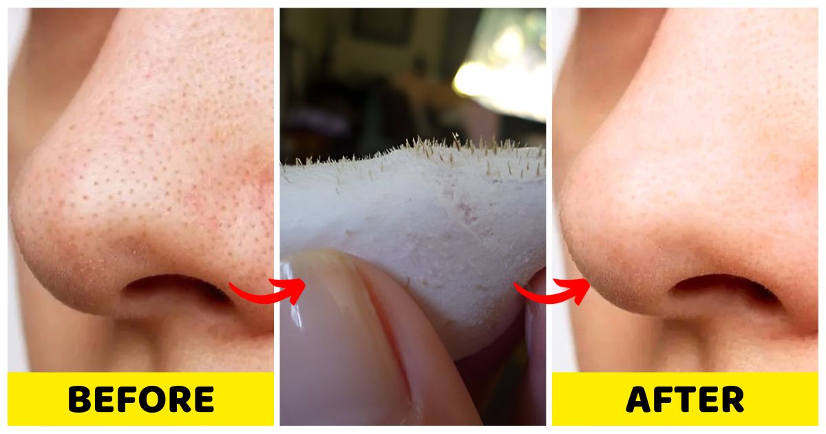 The Ultimate DIY Pore Strips To Get Rid Of Your Blackheads Woman