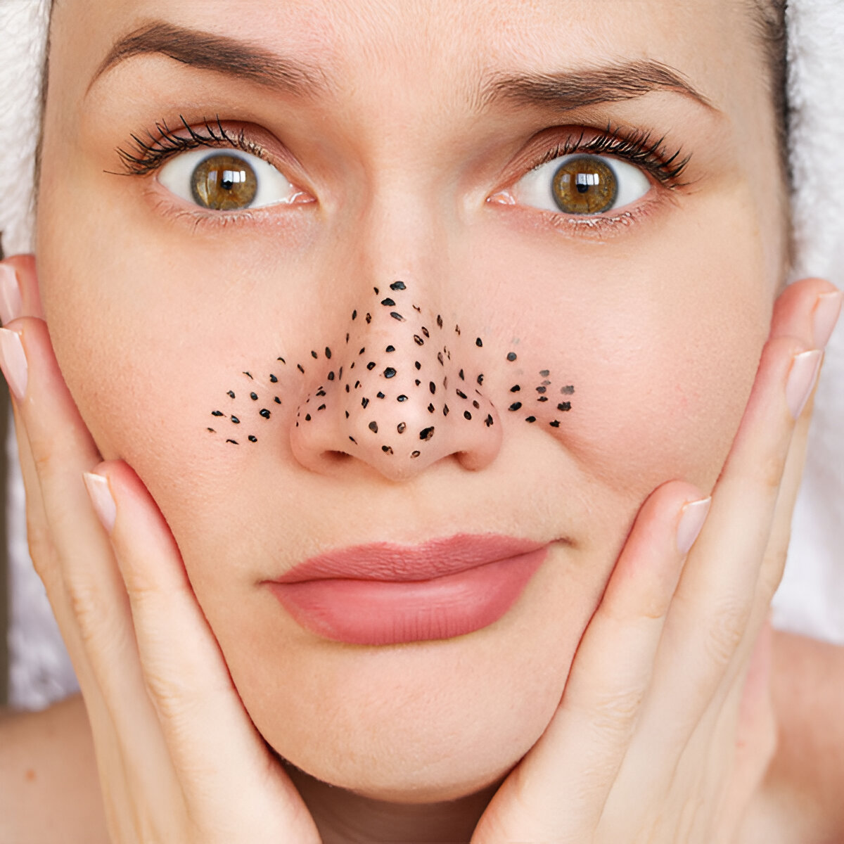 Remedies And Tips To Beat Blackheads