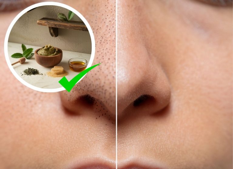 Remove-Blackheads-Naturally-Web