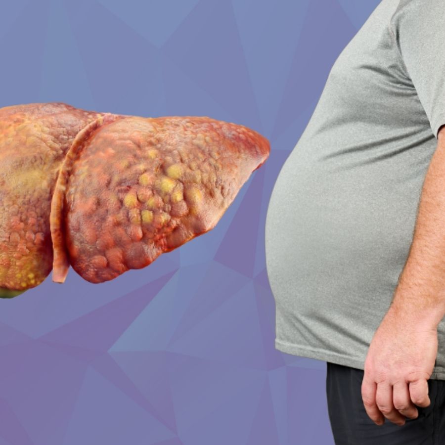 fatty-liver-disease