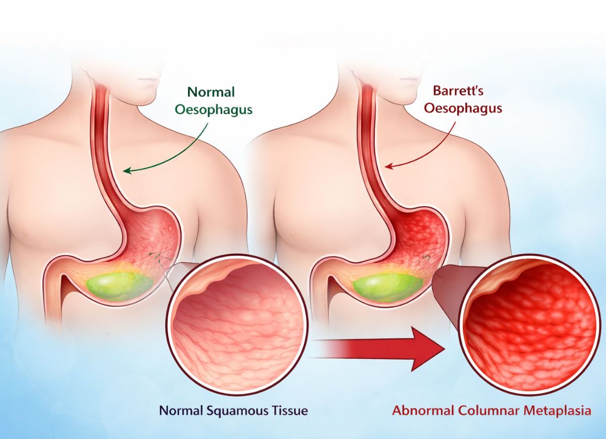 10 Symptoms of Barrett’s Oesophagus and How to Identify Them