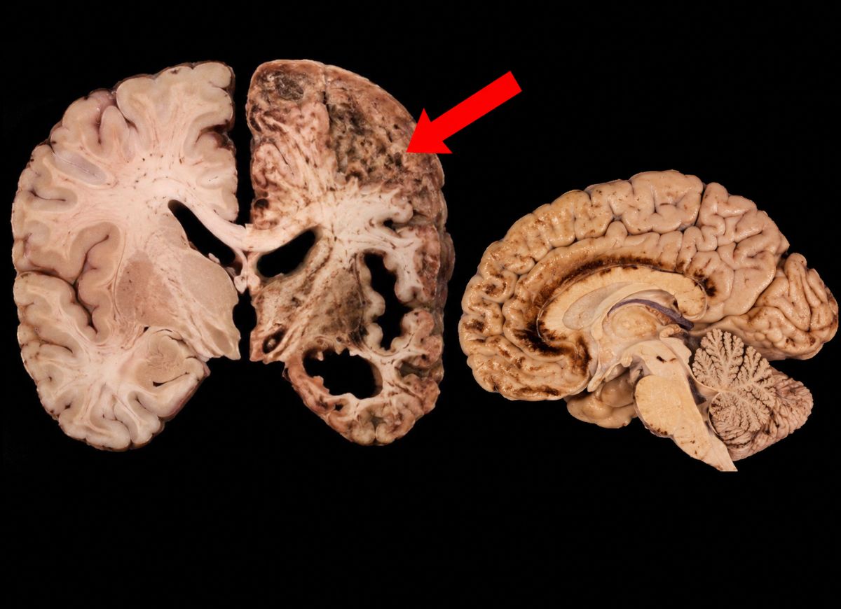 10 Telltale Signs of Chronic Traumatic Encephalopathy (CTE)