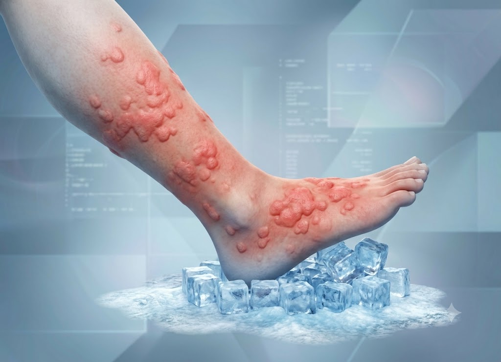 7 Signs of Cold Urticaria and When Cold Exposure Becomes Dangerous