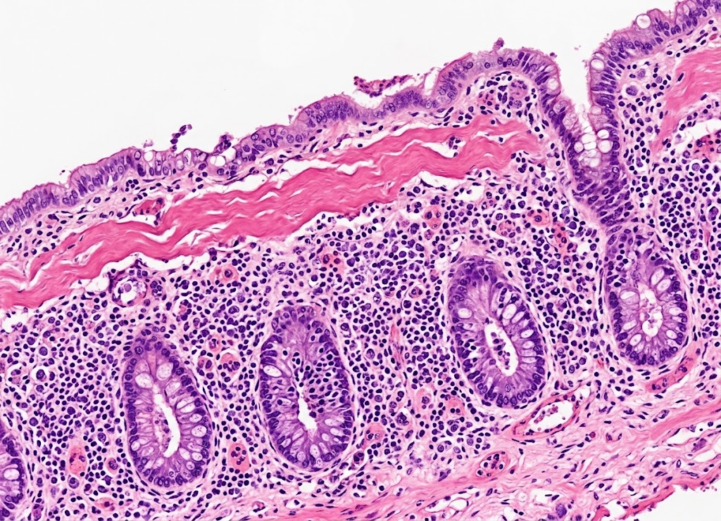 10 Things to Know About Microscopic Colitis and Chronic Diarrhea